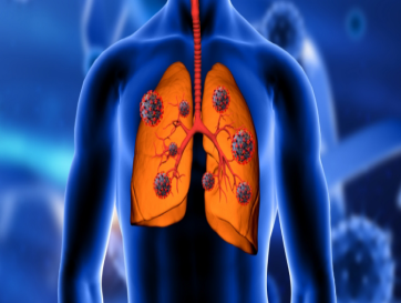 foto com imagem ilustrando o tema de DPOC